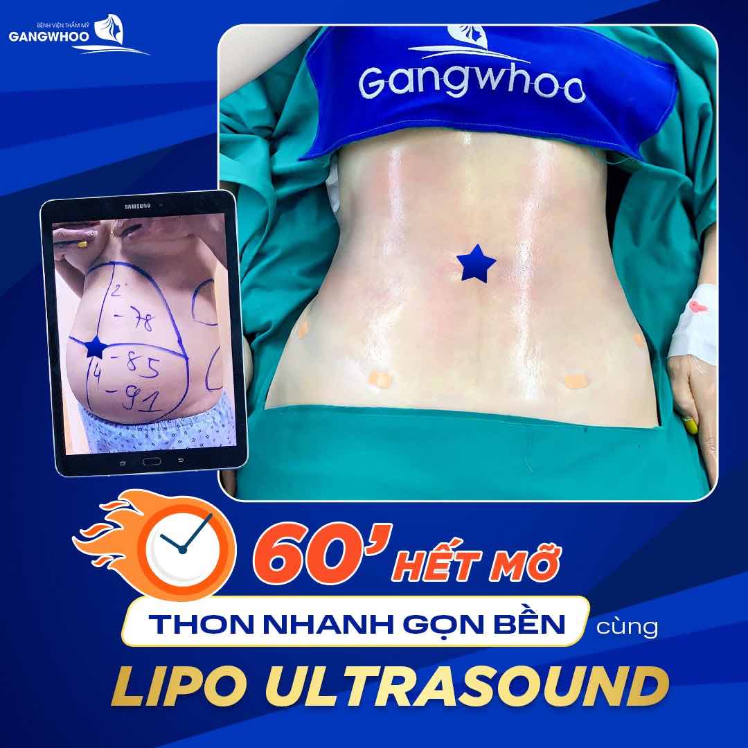 Tiêu diệt nhanh gọn mỡ thừa với Lipon Ultrasound tại Gangwhoo
