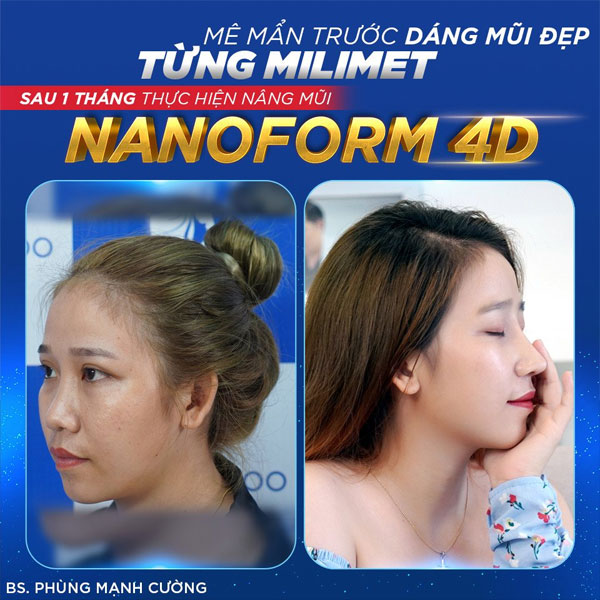 Nâng mũi Nanoform giúp khắc phục hầu hết các khuyết điểm của mũi