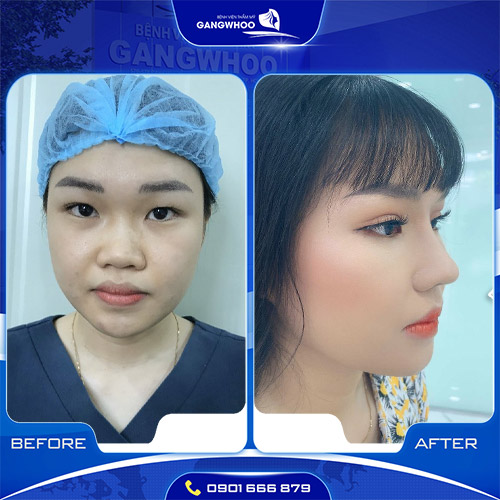 Khách hàng trải nghiệm dịch vụ nâng mũi tại Gangwhoo