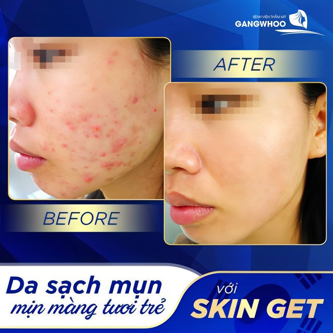 Tự tin hơn gấp 1000 lần sau khi da sạch mụn với Skin Get tại Gangwhoo