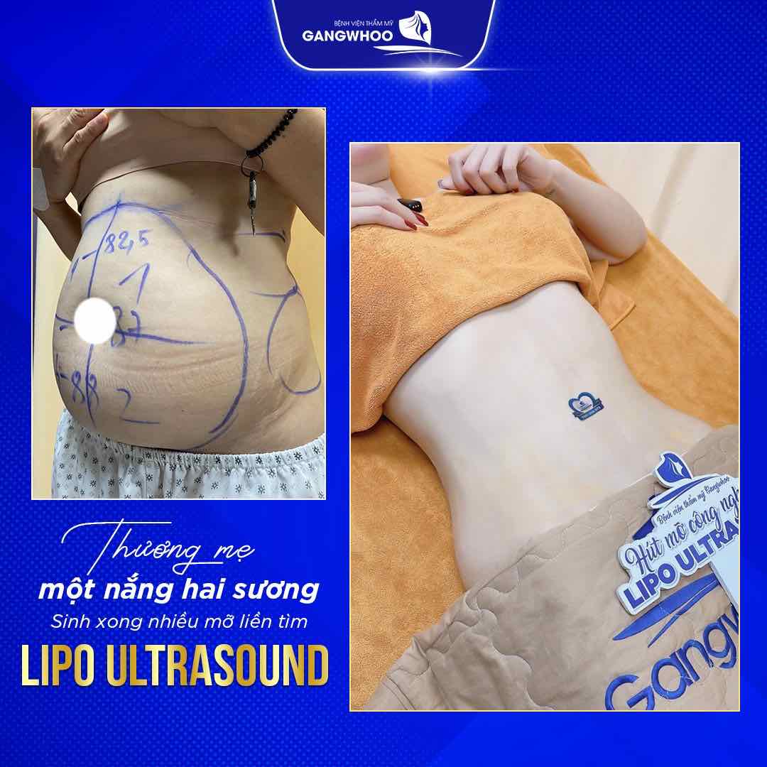 Giảm từ 2 - 4 lít mỡ sau một liệu trình Lipo Ultrasound tại Gangwhoo