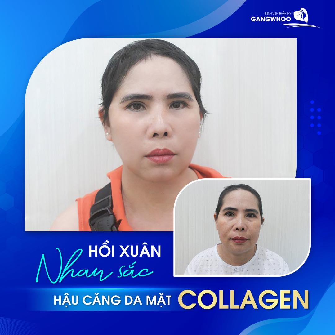 Giúp khách hàng lấy lại vẻ thanh xuân với phương pháp căng da mặt collagen tại Gangwhoo