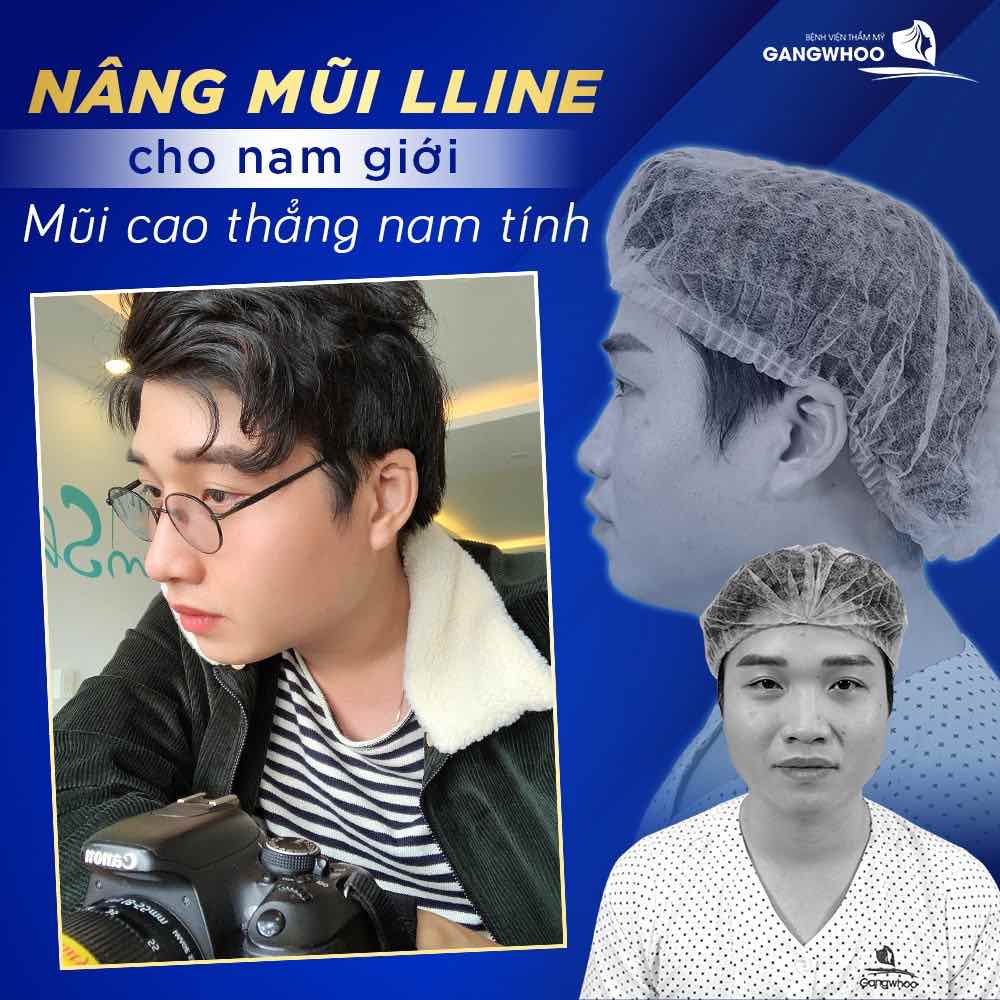Nâng mũi LLine cho vẻ đẹp chuẩn nam tính tại Gangwhoo