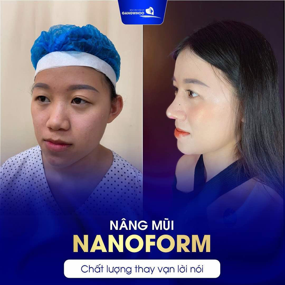 Thăng hạn nhan sắc sau 1 tháng nâng mũi nanoform