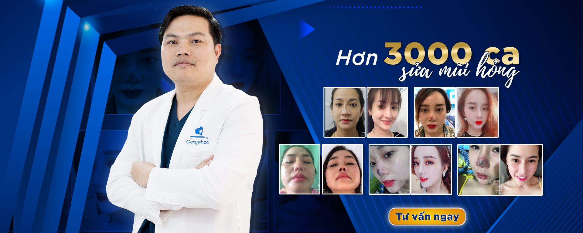 bác sĩ Phùng Mạnh Cường đã sửa mũi hơn 3000 khách hàng có mũi bị hỏng