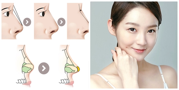 Nâng mũi bọc sụn tự thân là phương pháp nâng mũi giúp hạn chế tình trạng thủng đầu mũi