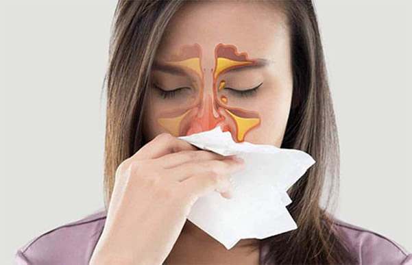 Đau đầu là dấu hiệu thông thường sau nâng mũi khi mắc bênh viêm xoang. Triệu chứng này sẽ hết sau 5 -7 ngày