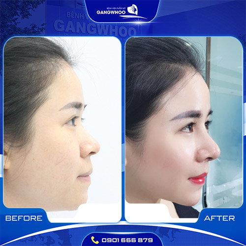 Nâng mũi cấu trúc khắc phục toàn bộ khuyết điểm trên khuôn mặt