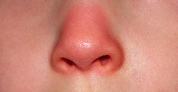 Hiện tượng mũi bị đỏ có thể xảy ra sau 1-2 năm sau khi nâng mũi