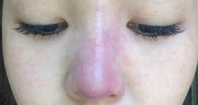 Những vết bầm sau khi nâng mũi không thuyên giảm theo thời gian thì bạn nên đến gặp bác sĩ để thăm khám