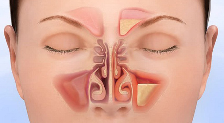 Bệnh nhân viêm xoang vẫn có thể nâng mũi như bình thường