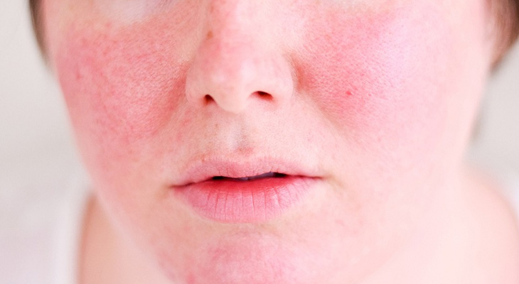 Chườm nóng sau nâng mũi sai cách có thể khiến da bị bỏng đỏ