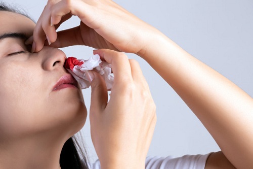 7 ngày đầu sau khi nâng mũi bạn không nên vận động mạnh vì dễ chảy dịch và máu