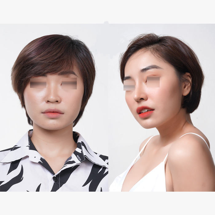  nâng mũi Hàn Quốc - Phương pháp tạo nét đẹp cá tính